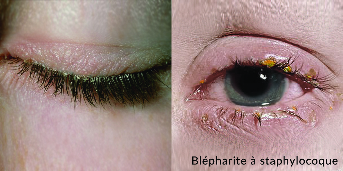 infections_yeux_blepharite_extensions_de_cils
